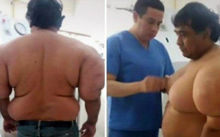 Δείτε την παραμόρφωση που υπέστη το σώμα ενός δύτη που ανέβηκε πολύ γρήγορα στην επιφάνεια (εικόνες, βίντεο)